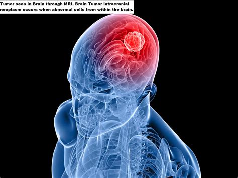 Brain Tumor Symptoms And Types Health And Disease