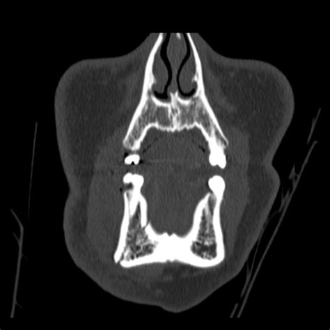 Mandibular Fracture Single Site Only Image