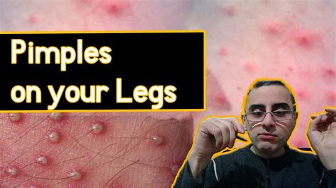 Pimples On The Legs Funiculitis Causes Treatment Prevention Youtube