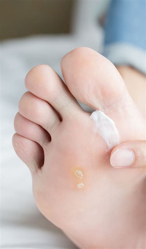 How To Tell If You Have Athletes Foot Causes And Best Treatments Bilt Labs