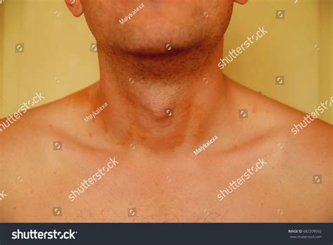 Allergic Skin Rash Spots On Neck Stock Photo 682209592 Shutterstock