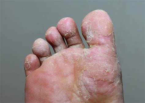 Athletes Foot Tinea Pedis Oc Foot And Ankle Clinic