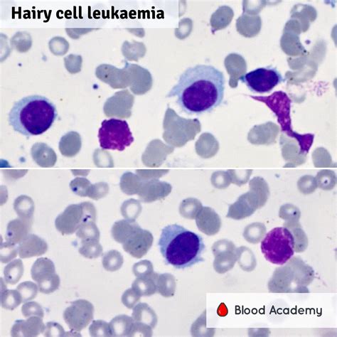 Hairy Cell Leukaemia Blood Academy