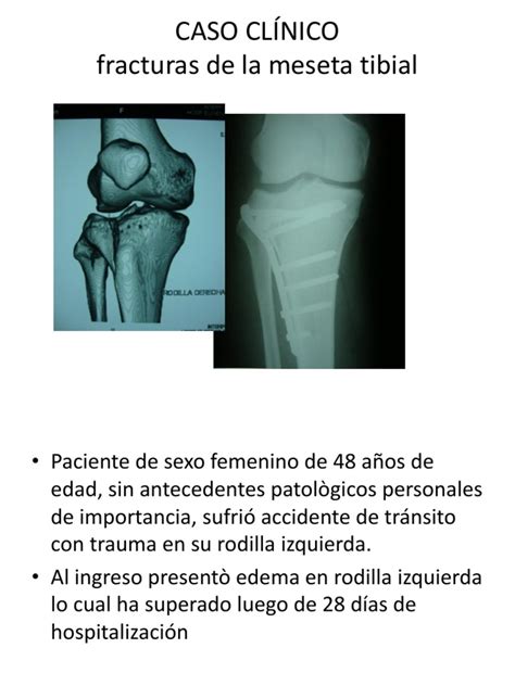 Fracturas Meseta Tibial Traumatologia Cirugía Ortopédica