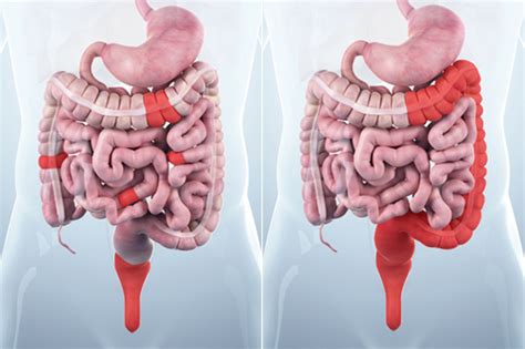 What Is The Difference Between Crohns Disease And Ulcerative Colitis