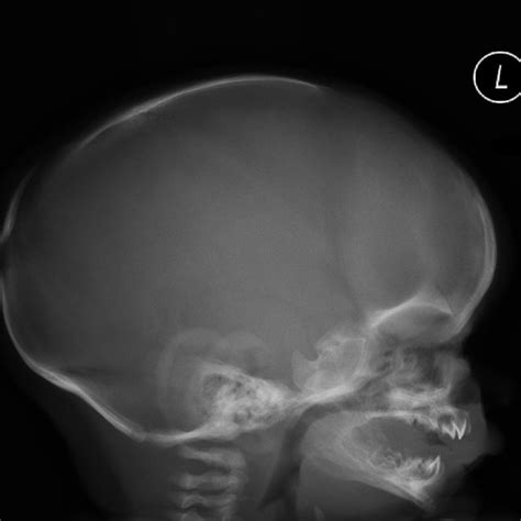 Frontal Skull X Ray In A 3 Month Old Male There Is Hypotelorism