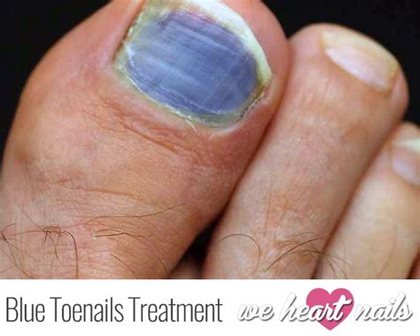 Bruised Blue Toenails Causes Prevention And Treatments