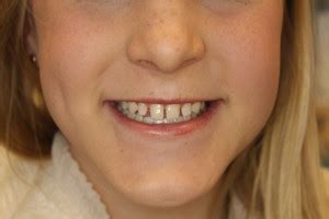 46 how to get rid of gaps in my teeth. gap-between-front-teeth - Southpointe Dental: Lincoln's ...