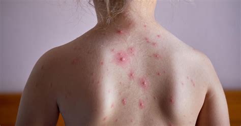Covid Vaccine Rash Pictures Chickenpox In Adults Symptoms