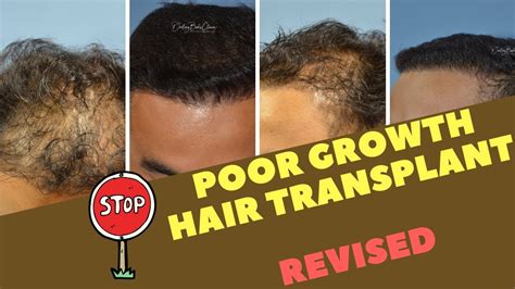 After hair restoration, the hair growth timeline requires patience. Reason for POOR GROWTH after a Hair Transplant & Revision ...