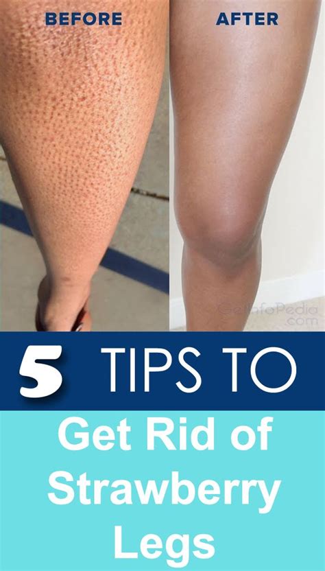 Strawberry Legs 5 Tips To Get Rid Of Strawberry Legs Getinfopedia
