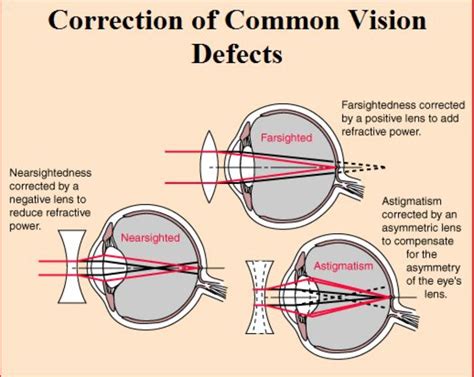 gcse biology eye focusing correcting defects and glasses alternatives diagram quizlet