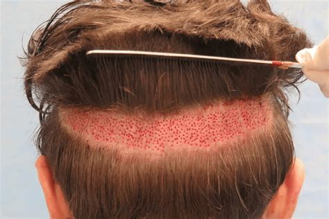 Shedding After Hair Transplant It Is Normal Regrow Hair Clinic
