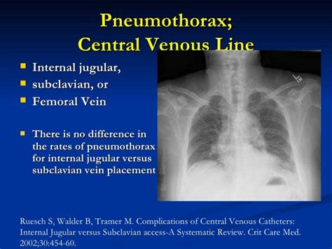 Pneumothorax In Icu