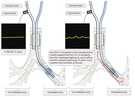 Dual Lumen Endotracheal Tube Deranged Physiology