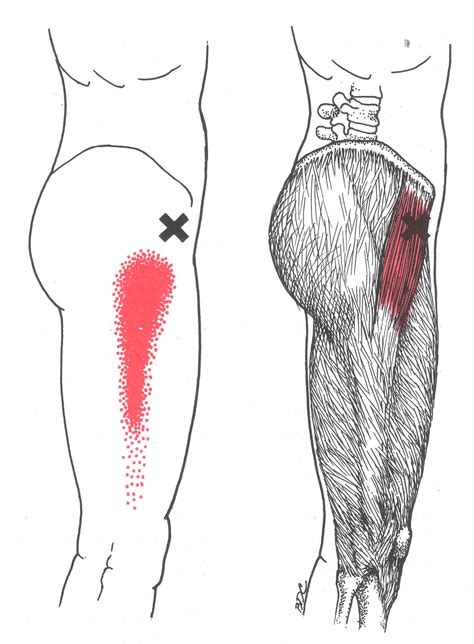 Tensor Fasciae Latae The Trigger Point And Referred Pain Guide