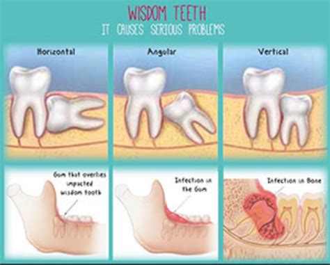 Wisdom Tooth Extraction What To Expect South West London