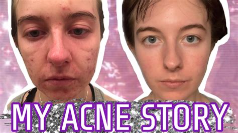 Is Accutane Worth It My Acne Story Youtube