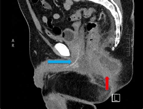 Cureus Occult Perirectal Abscess Causing Acute Urinary Retention