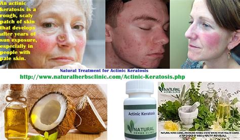 Natural Herbs Clinic Natural Treatment Of Actinic Keratosis A Skin