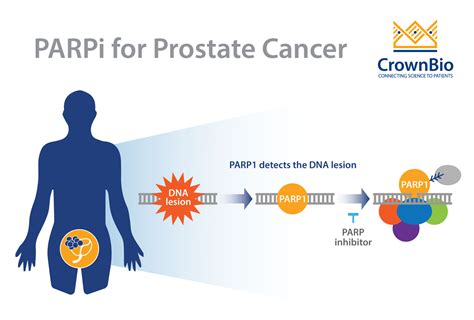 The Latest Developments On Parp Inhibitors For Prostate Cancer Treatment