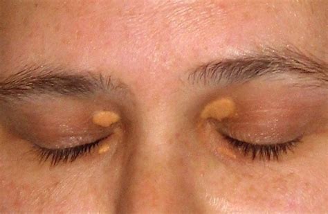 What Are The White Spots Under Eyes New Health Advisor