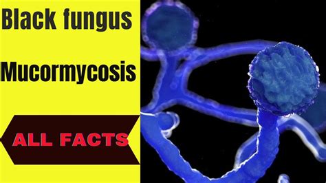 Black Fungus Mucormycosis Youtube