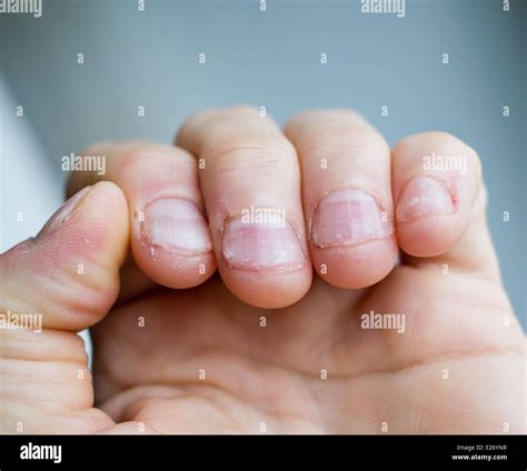 Bitten Nails Hi Res Stock Photography And Images Alamy