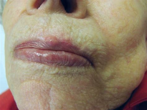 Lip Basal Cell Carcinoma Pictures Sitelip Org