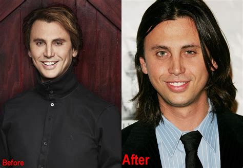 Jonathan Cheban Plastic Surgery Before And After Face Photos