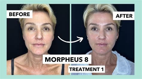 Morpheus 8 Treatment Non Surgical Facelift Before And After Treatment 1 Youtube