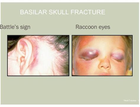 Basal Skull Fracture Medizzy