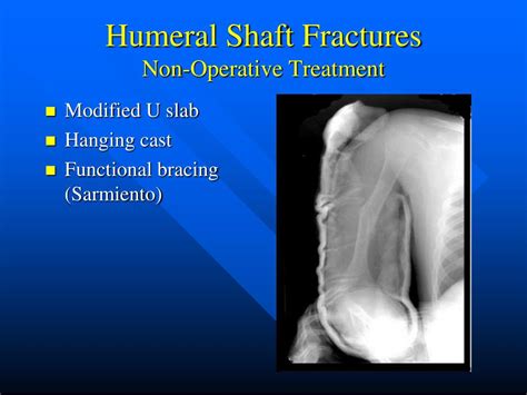 Ppt Fractures And Dislocations Of The Shoulder Girdle And Elbow And
