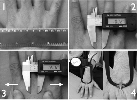 A Novel In Vivo Skin Extensibility Test For Joint Hypermobility The