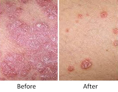 Dermarest Psoriasis Medicated Skin Treatment Side Effects