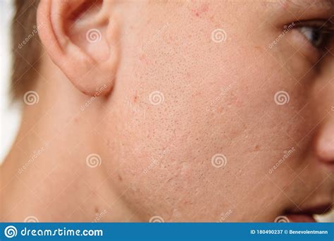 Acne Scars On The Face Stock Image Image Of Problems 180490237