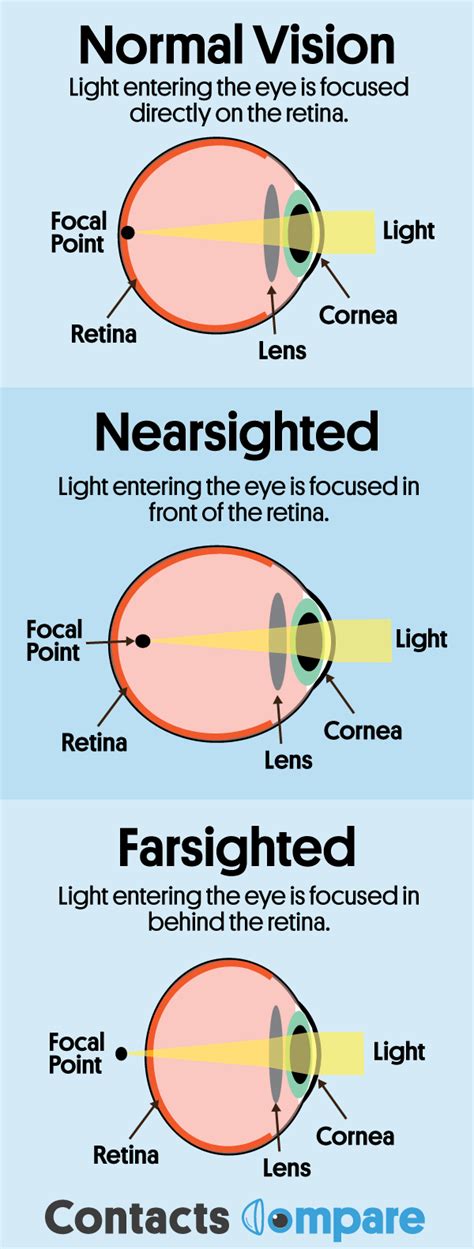 Nearsighted Vs Farsighted Which Is More Common Greet Record Photography