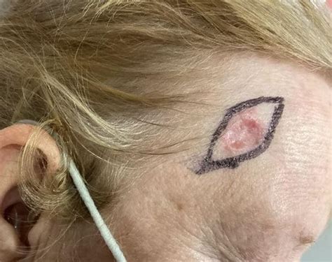 Clinical Challenge Crusted Bleeding Patch On Forehead Mpr