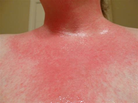 Allergic Reaction Rash Pictures Pictures Photos