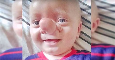 Birth Defect Results In Boys Brain Growing Through His Nose Sf Globe