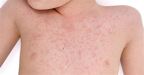 Hives In Children Causes And Treatment