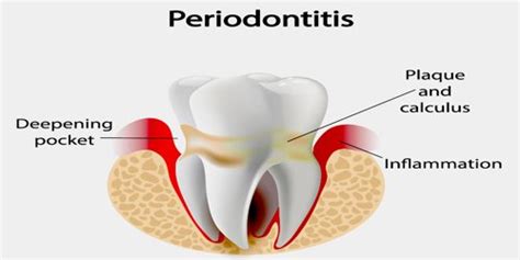 Periodontitis Assignment Point