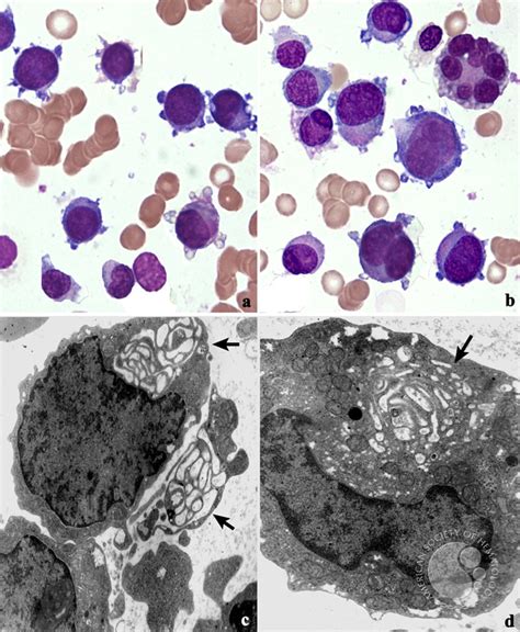 Erythroid Leukemia Mimicking Megakaryocytic Leukemia