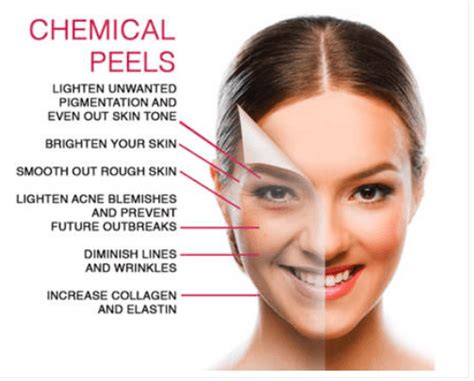 What Can A Chemical Peel Do For You Sweet Spot Medispa Medical Spa