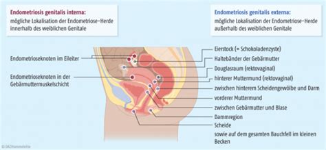 Endometriosis is defined as the presence of normal endometrial mucosa (glands and stroma) abnormally implanted in locations other than the uterine cavity (see the image below). Pharmakotherapie der Endometriose