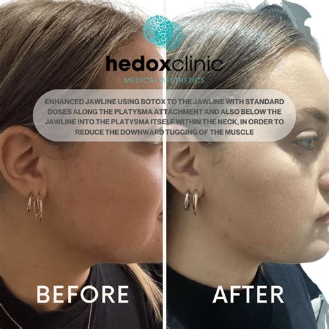 Advanced Botox London Anti Wrinkle Treatment Hedox Clinic