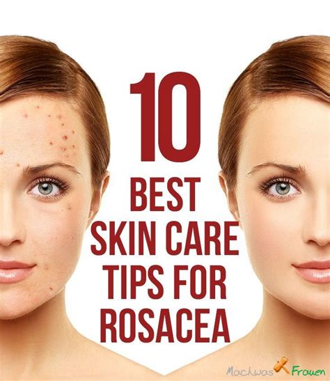 Der name akne rosacea kann ein wenig irreführend sein, weil es fast andeutet, dass akne rosacea verursacht. Wie man Rötungen im Gesicht loswird - Akne Heilen ...
