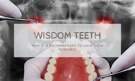 4 Tips To Recovering After Having Your Wisdom Teeth Removed