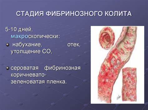 Диета при кишечных воспалениях