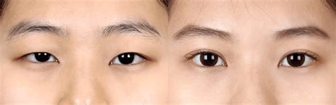Can Double Eyelids Develop Over Time Spore Mums Share Their Stories